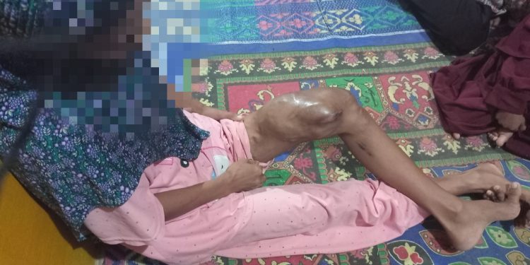 Sakiyah, Penderita Tumor Ganas di Muarojambi Butuh Bantuan Dermawan