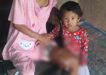 Terancam Diamputasi, Penderita Tumor di Muaro Jambi Butuh Bantuan 